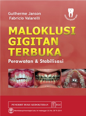 Maloklusi Gigitan Terbuka : Perawatan & Stabilisasi