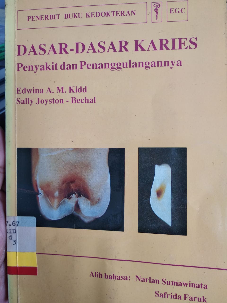 Dasar-dasar karies : Penyakit dan penanggulangannya