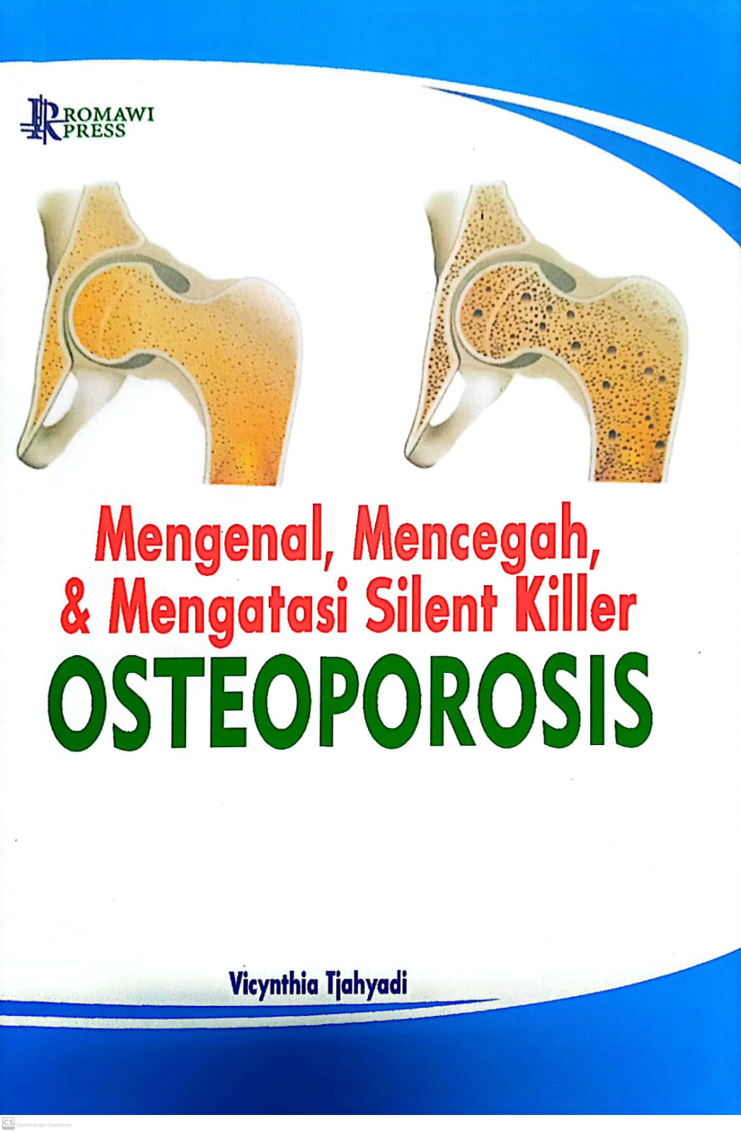 Mengenal, mencegah, dan mengatasi silent killer osteoporosis
